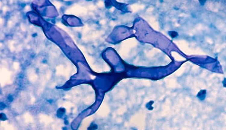 Treatment for Mucormycosis Free Under Health Schemes